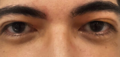 Blepharoplasty Before & After Patient #408