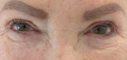 Blepharoplasty Before & After Patient #411