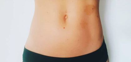 Liposuction Before & After Patient #376