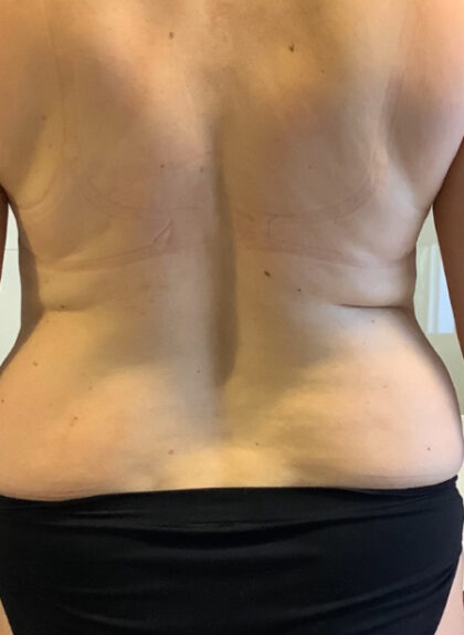 Liposuction Before & After Patient #385