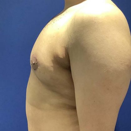 Gynecomastia Before & After Patient #775