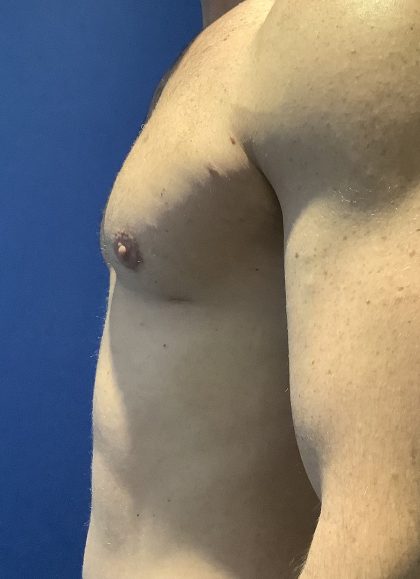 Gynecomastia Before & After Patient #779